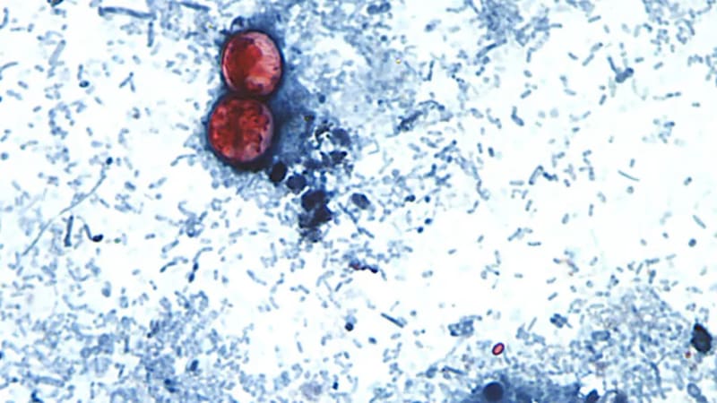 US Investigates Nationwide Cyclospora Parasite Outbreak