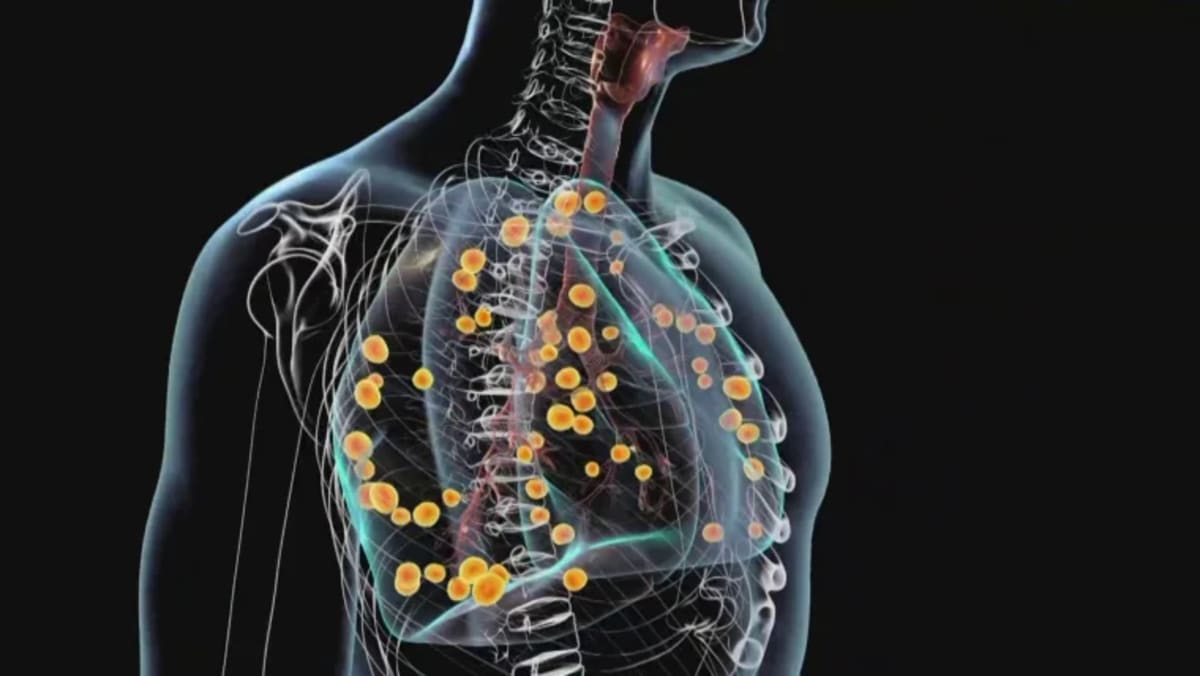 CDC Investigates Clusters of Severe Respiratory Illness in Five States; Cause Remains Unknown