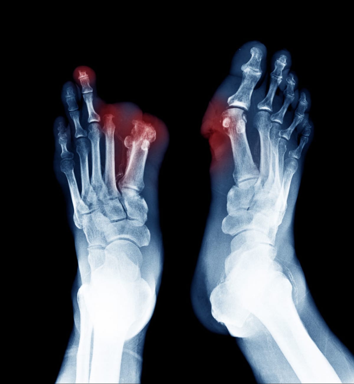 AI Powered Toe Scan Offers Hope in Fight Against Peripheral Artery Disease