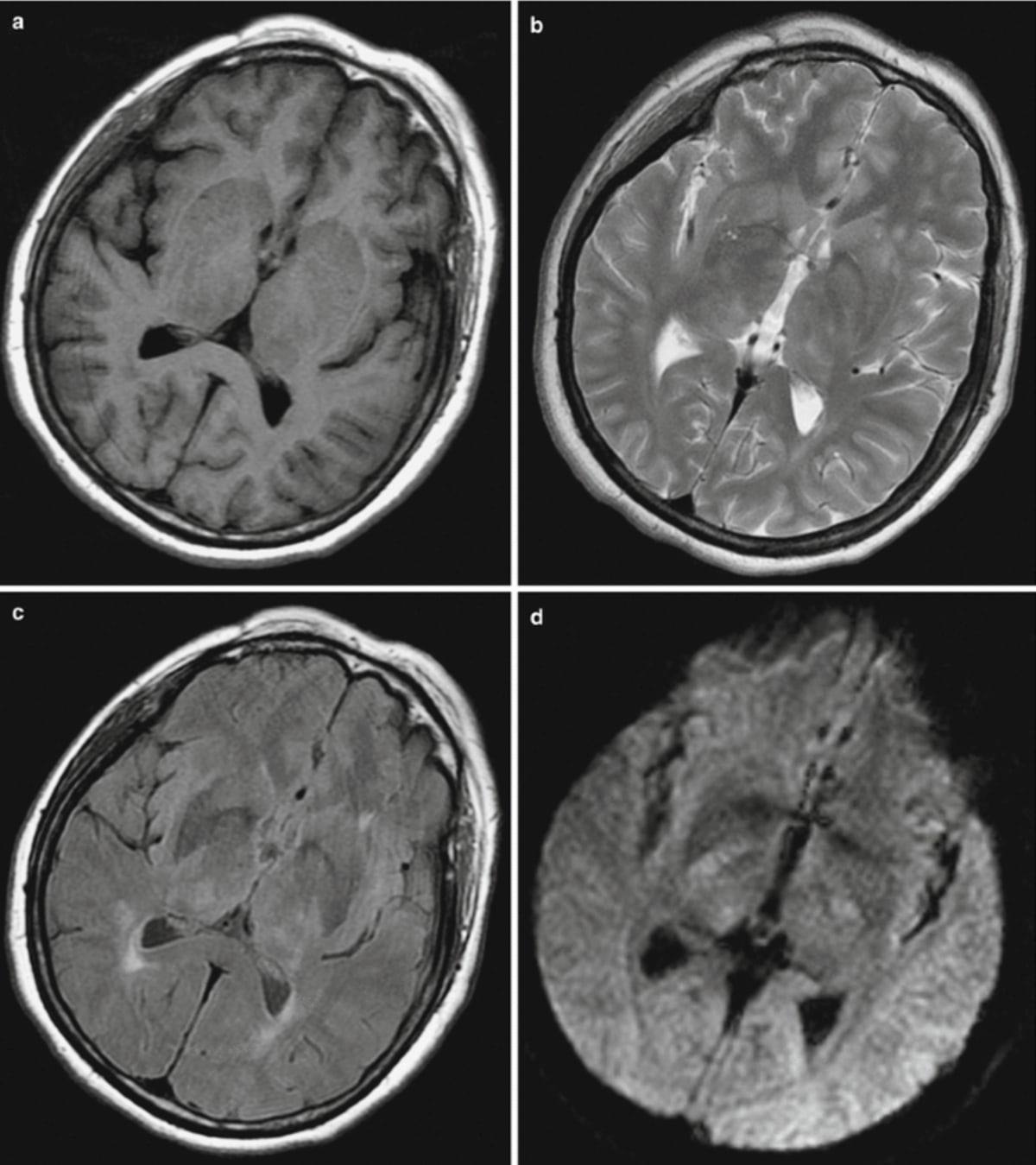 Encephalitis Rising: Silent Brain Inflammation Demands Urgent Action, Experts Warn