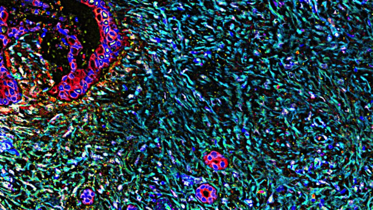 Pancreatic Cancer Drug Shows Promise Beyond Initial Target, Sparking Broader Clinical Interest