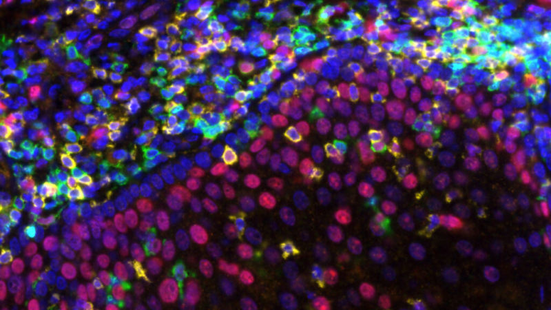 Low Dose Immunotherapy Could Expand Cancer Treatment Access in Low Income Nations