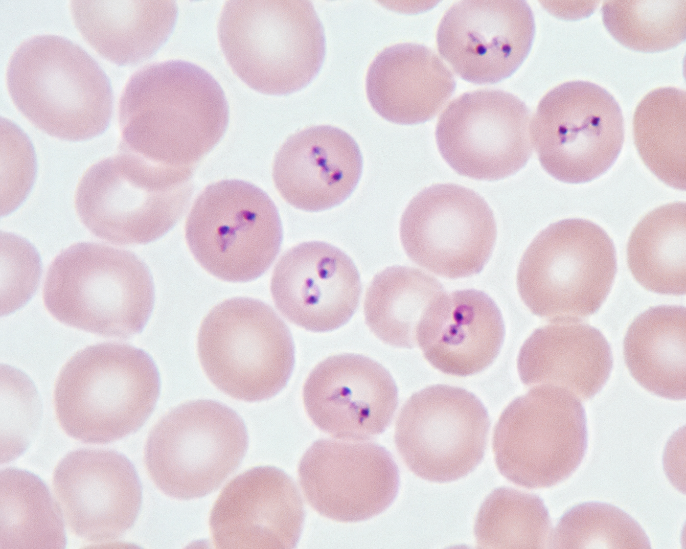 Babesiosis: Symptoms, Causes, and How to Protect Yourself