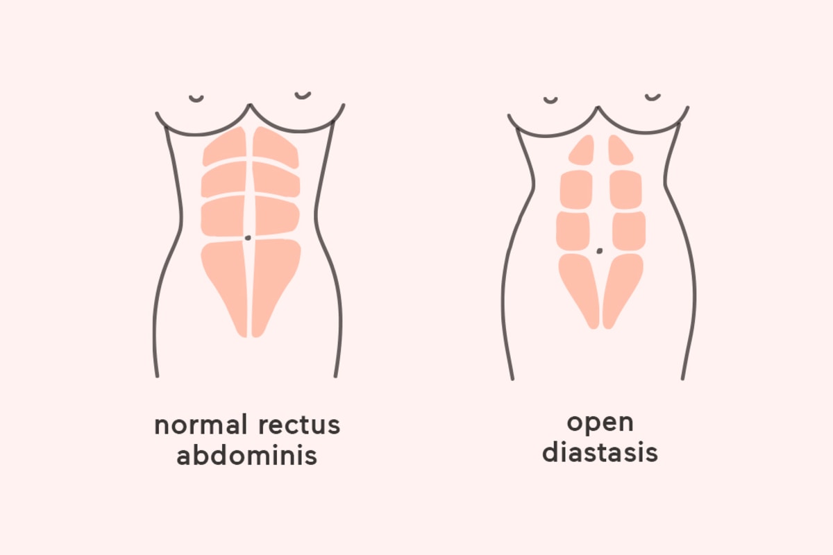 Diastasis Recti Exercises: Everything You Need to Know About How to Fix Diastasis  Recti