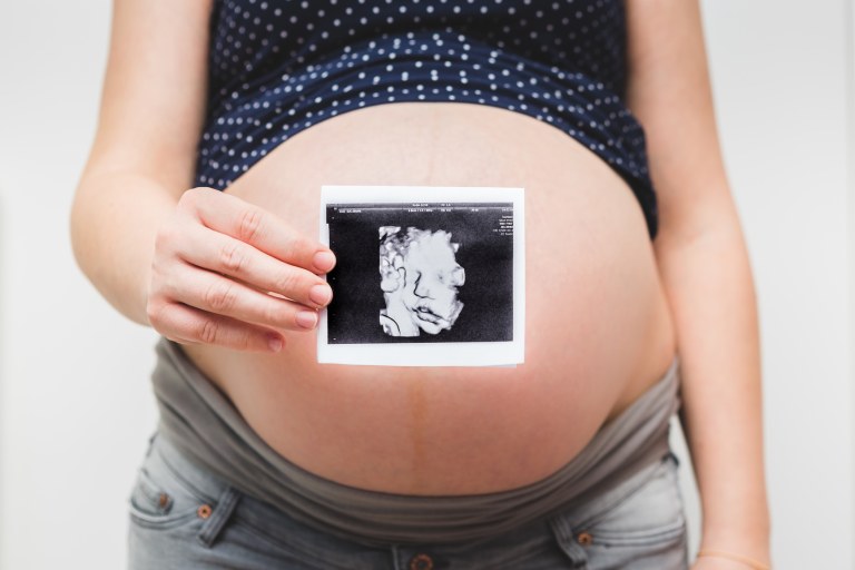 20-Week Ultrasound Explained