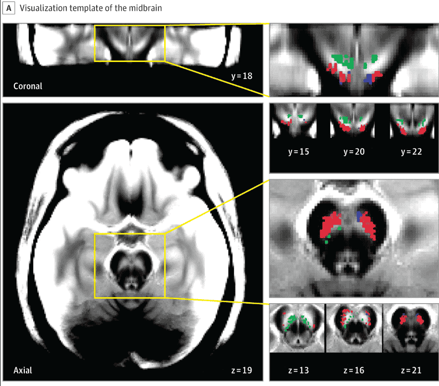 hormon dopamine psikosis ganja