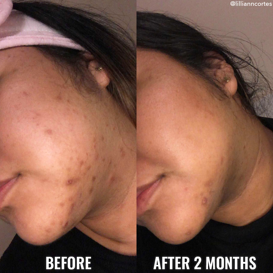 Color-Correcting Acne Scars Before and After