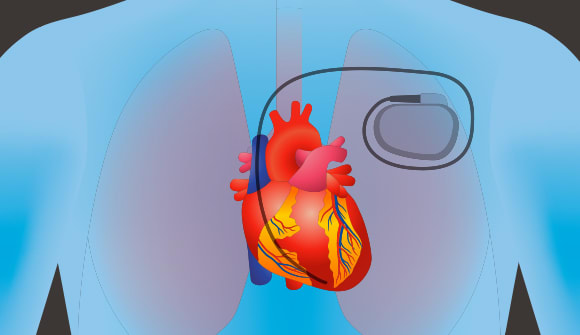 illustration of heart pacemaker