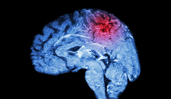 photo for Which stroke is striking? article