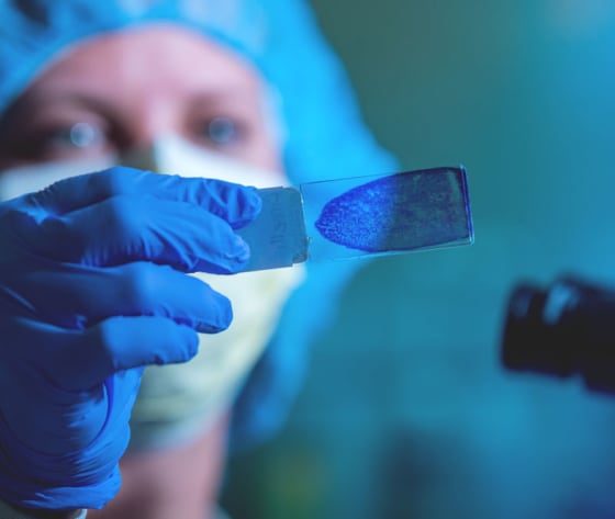 A close up of a microscope slide with cancer cells, held by a researcher wearing gloves and mask.