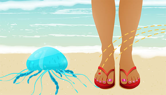 jellyfish_sting