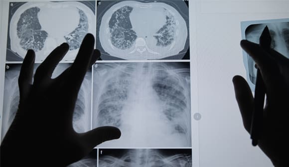 lung cancer screening