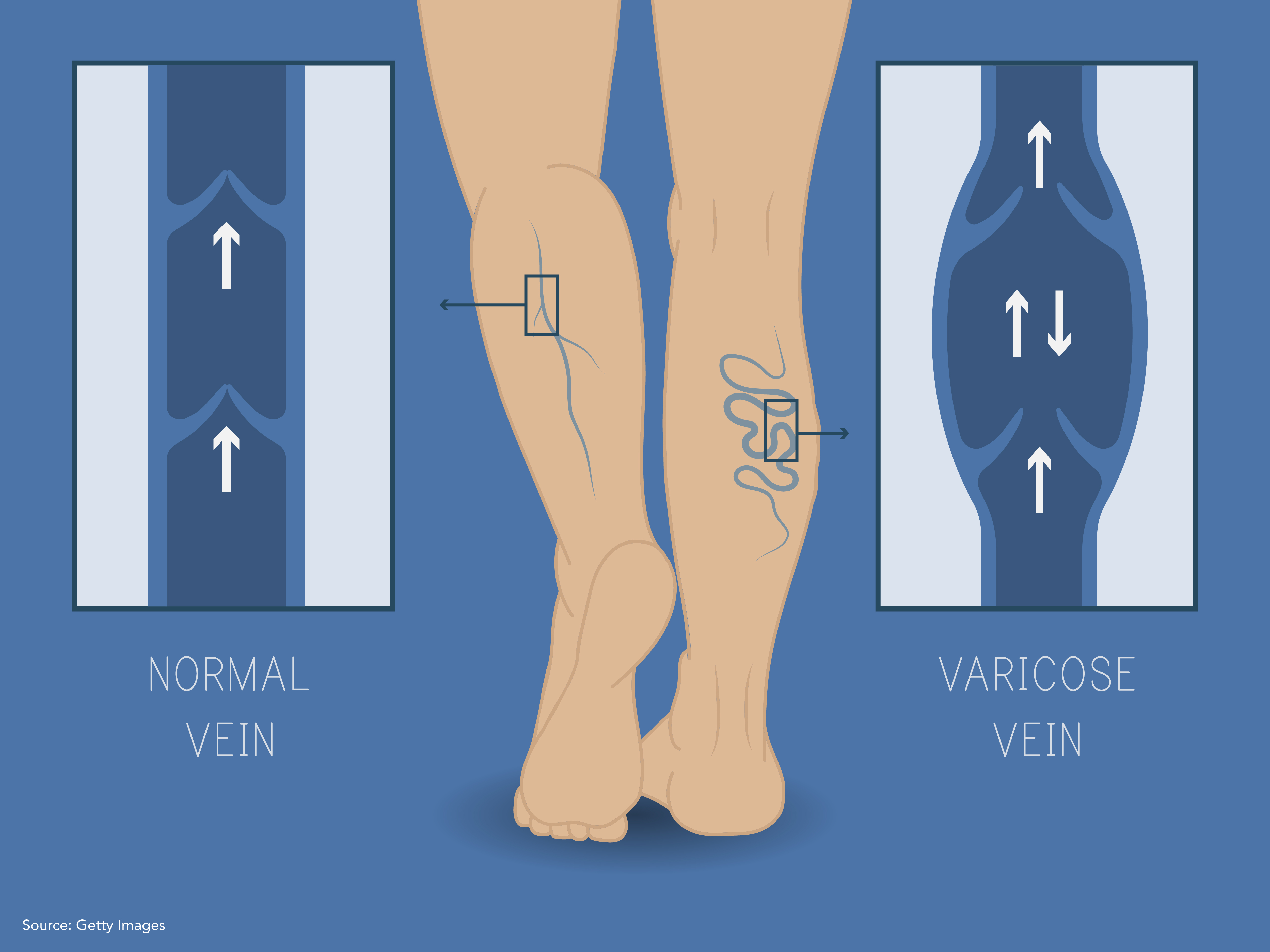 VaricoseVeins