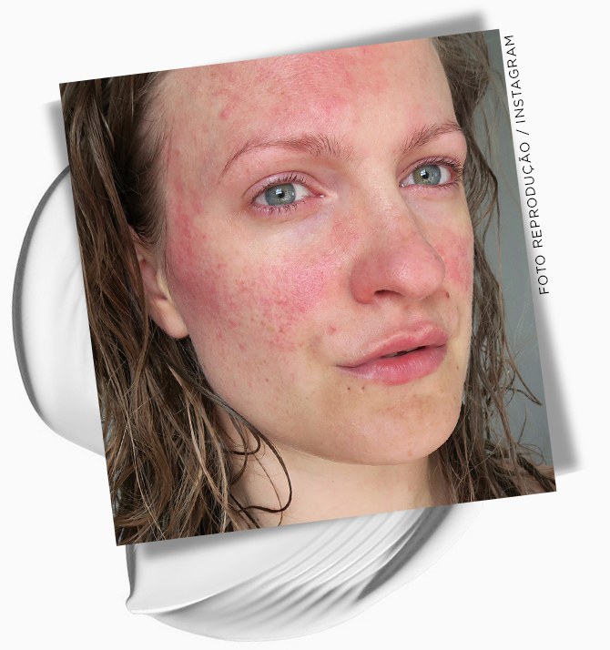 Rosacea la de que se produce