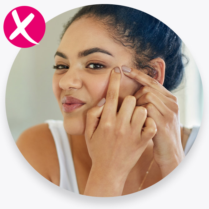 Que no comer para evitar acne