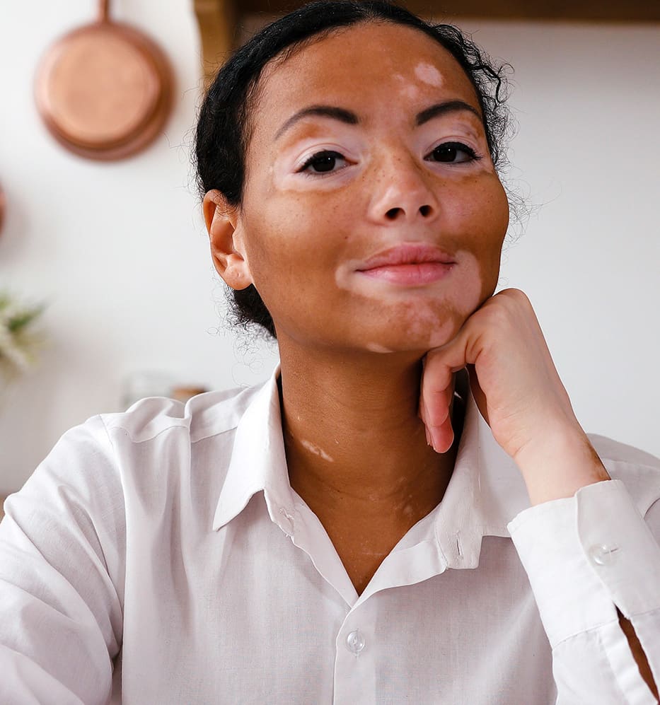 O que é vitiligo? Tire suas dúvidas