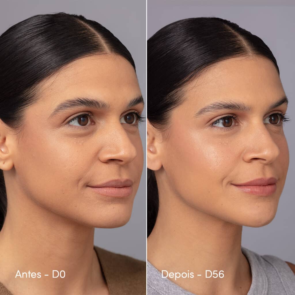 Antes e depois de tratamento para suavização de linhas e olheiras profundas