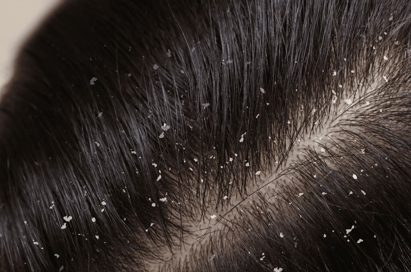 Raiz de cabelo com caspa