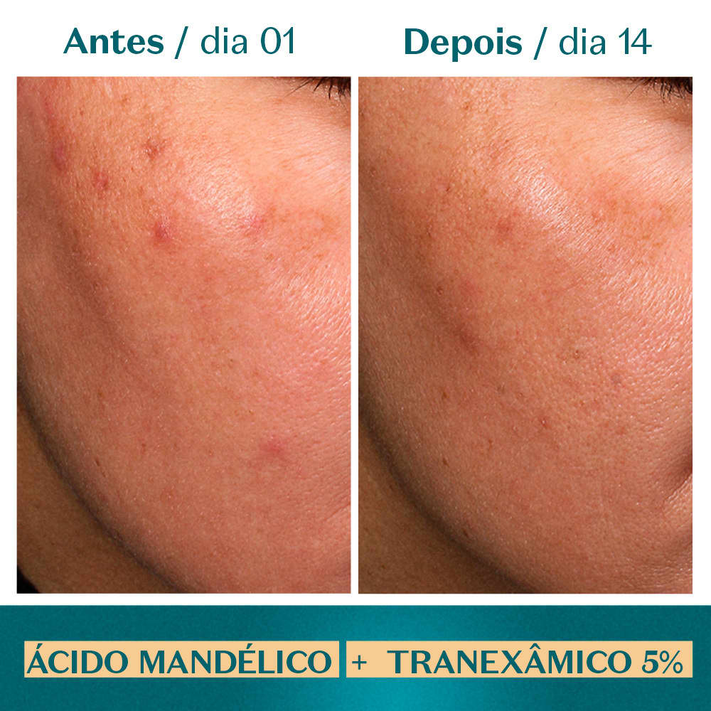 Fotos do antes e depois de uso do Sérum de Botik Ácido Mandélico