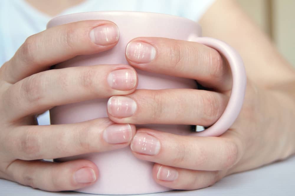 A imagem foca nas mãos se uma pessoa segurando uma caneca, suas unhas possem manchas brancas