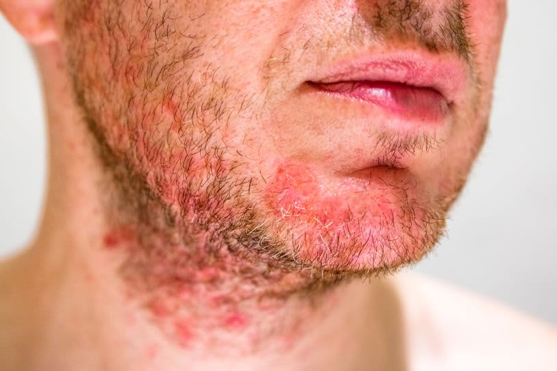 Close em rosto de homem com barba e pele irritada com manchas vermelhas causadas pelos fungos na barba