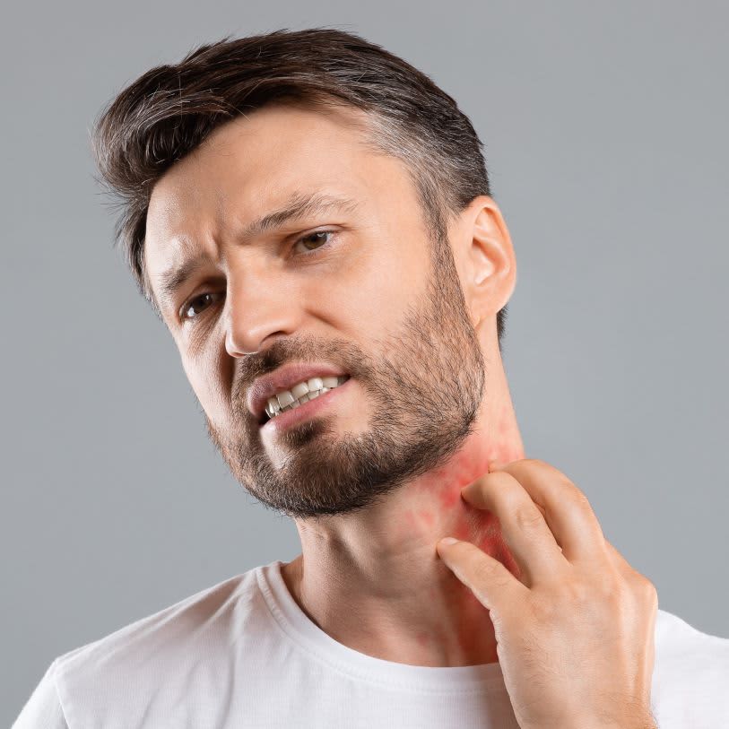 Homem com cabelos escuros e barba cheia com uma expressão de desconforto. Ele coça a região da barba que tem uma mancha vermelha causada por fungos.