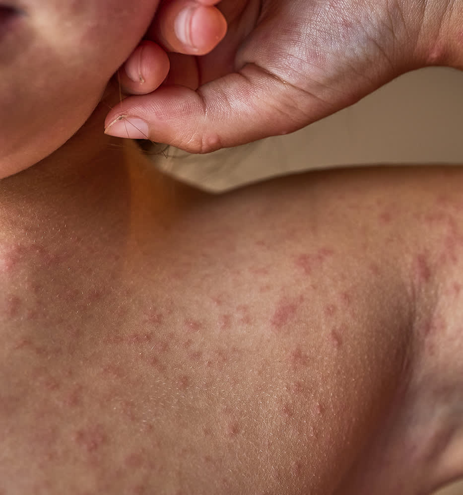 Dermatite atópica: como cuidar?