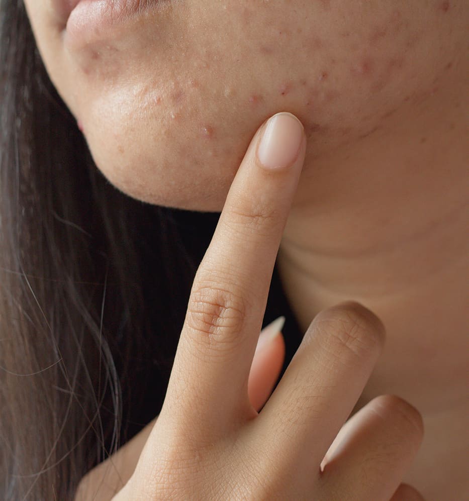 Como tirar manchas de espinha do rosto