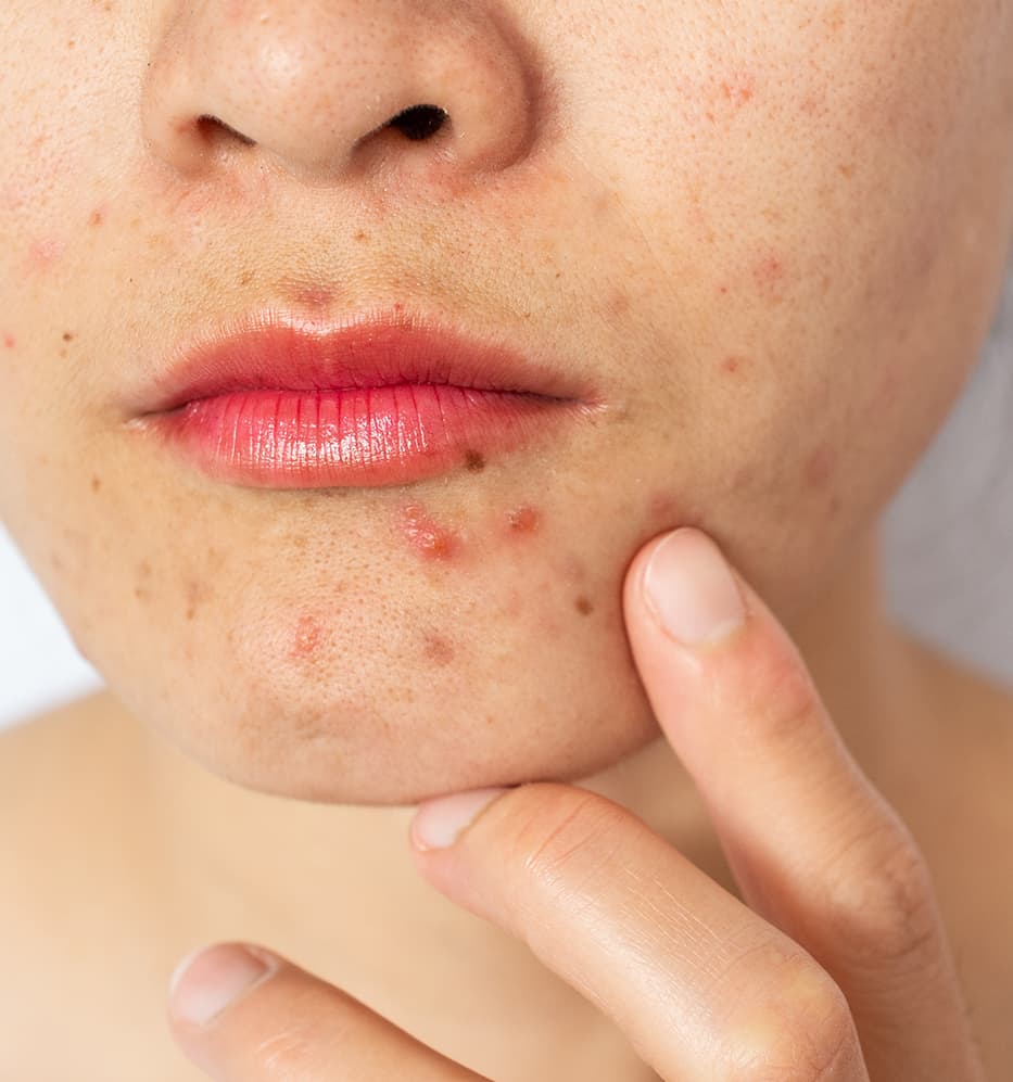 10 mitos e verdades sobre espinha