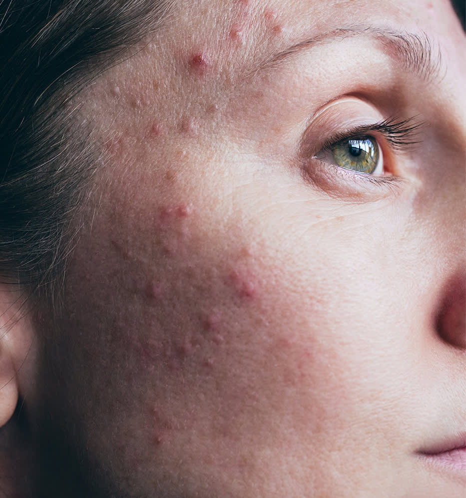 10 mitos e verdades sobre espinha