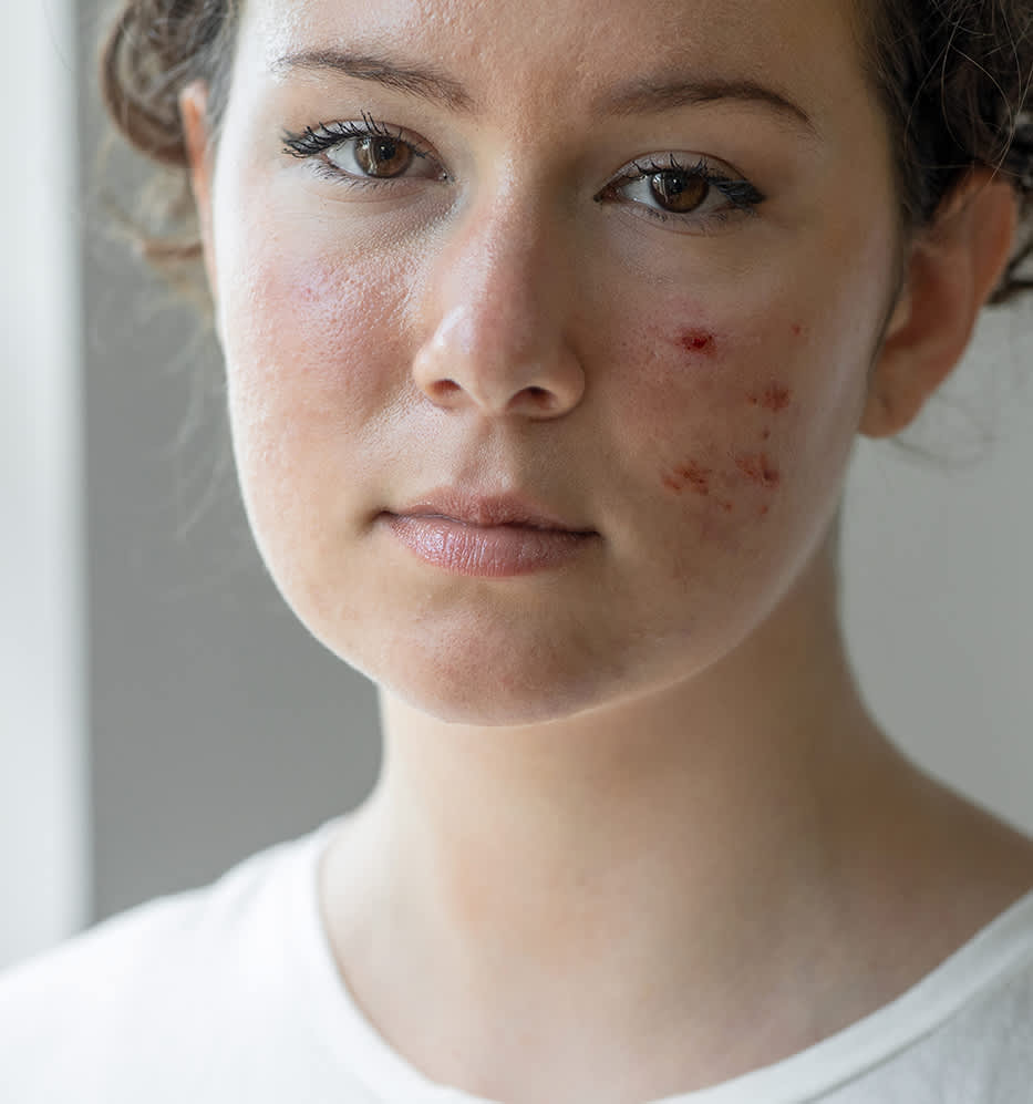 10 mitos e verdades sobre espinha