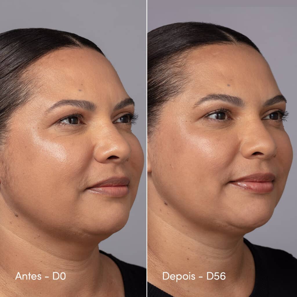 Mulher no antes e depois da redução da papada