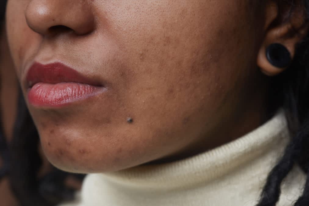 mulher negra pele com acne