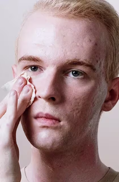 Foto de jovem de pele clara, cabelos loiros e olhos claros, sem barba, passando algodão de limpeza de pele na pele acneica.