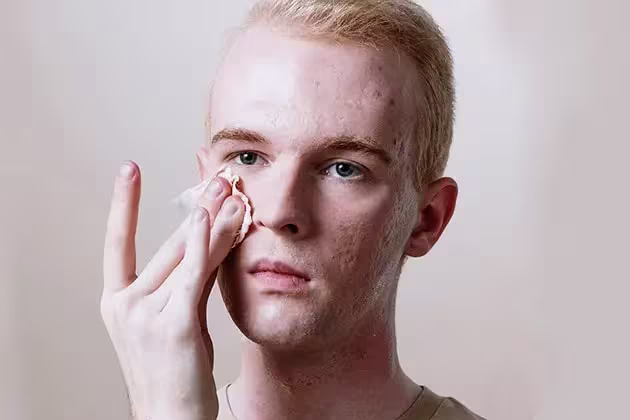 De frente para a câmera, jovem loiro de pele clara e com acne, olhos azuis, cabelos curtos e camiseta bege, limpa o rosto com lenço umedecido em gel de limpeza facial.