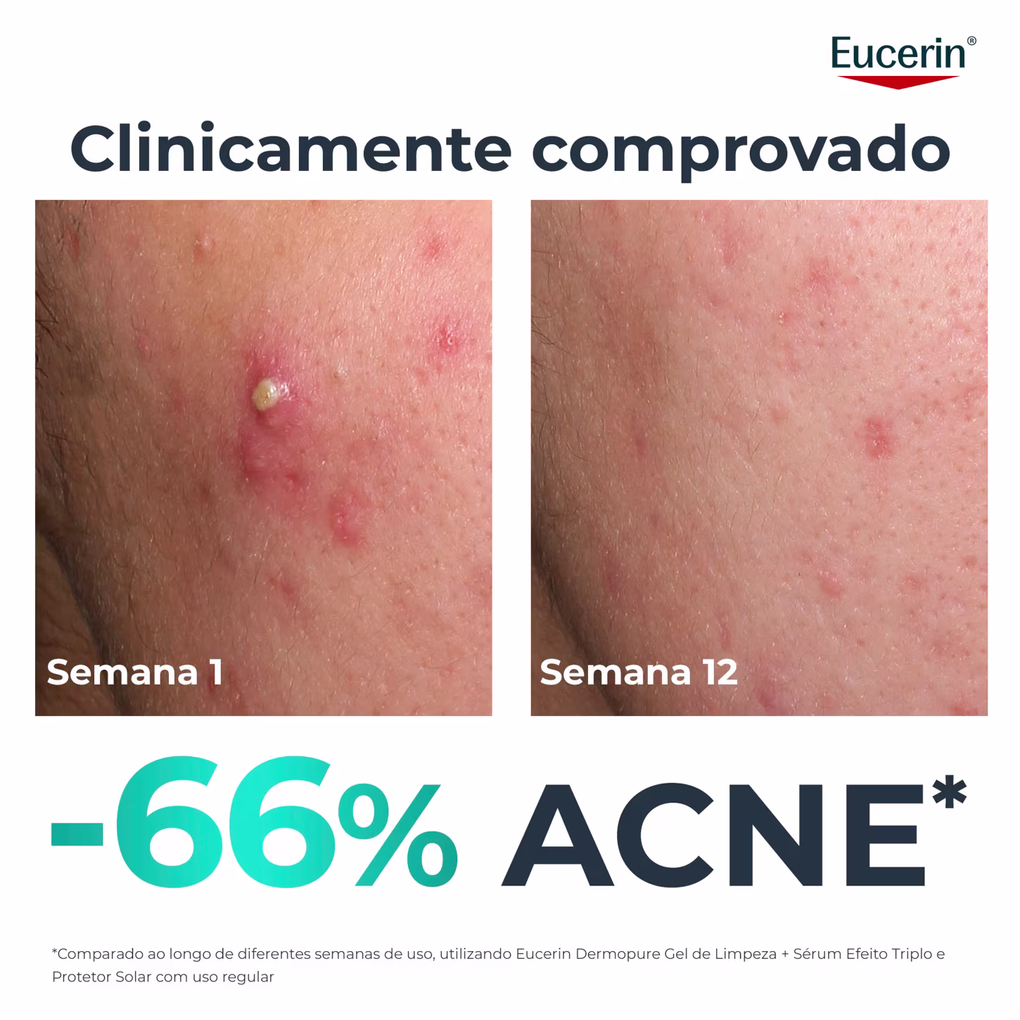 Imagem de antes e depois de 12 semanas de uso de produto Eucerin para acne, mostrando redução de 66% nos sinais de acne.