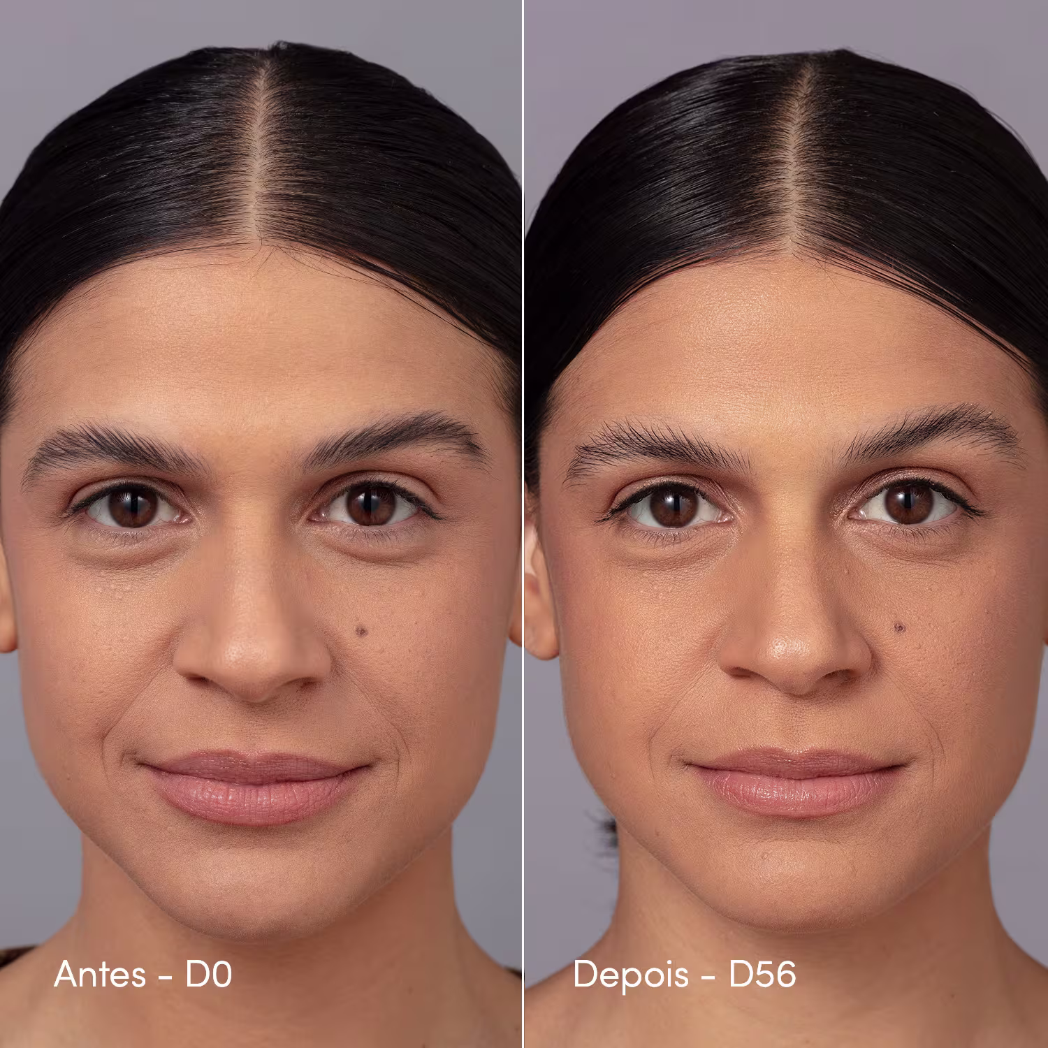 Duas fotos da mesma modelo, indicando o "Antes e Depois", com 56 dias de diferença, indicando as diferenças perceptíveis do uso contínuo do produto de Neo Dermo.