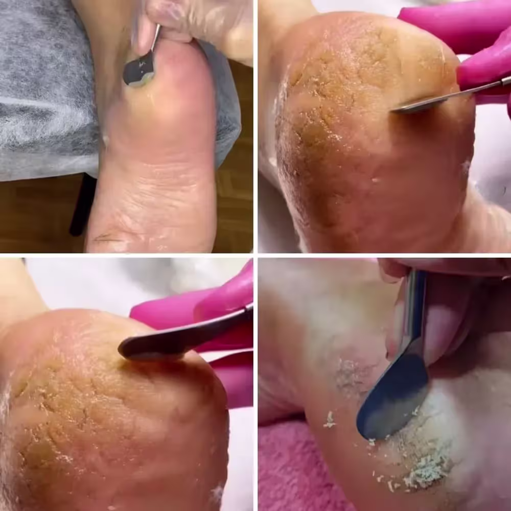 Amaciante de Calos e Calosidades Cora Brasil Spa dos Pés, 100ml.