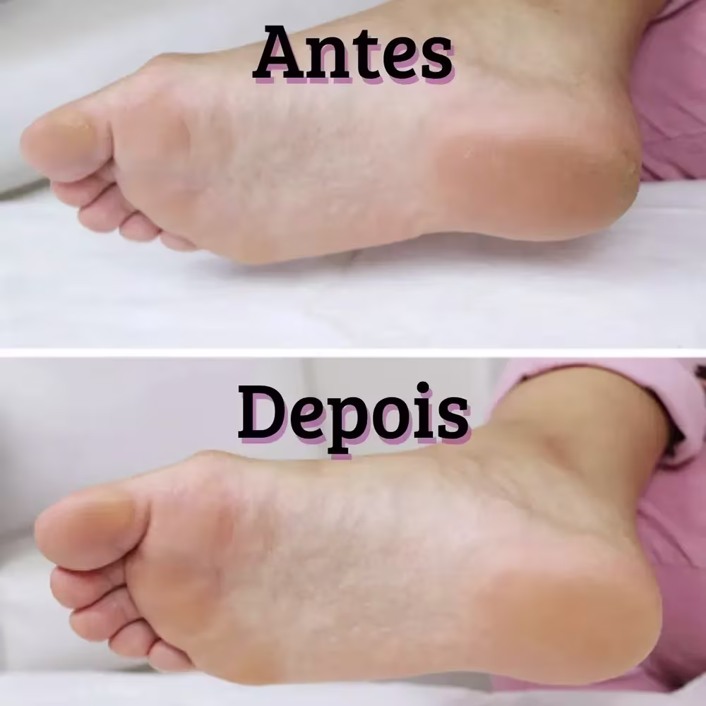 Amaciante de Calos e Calosidades Cora Brasil Spa dos Pés, 100ml.