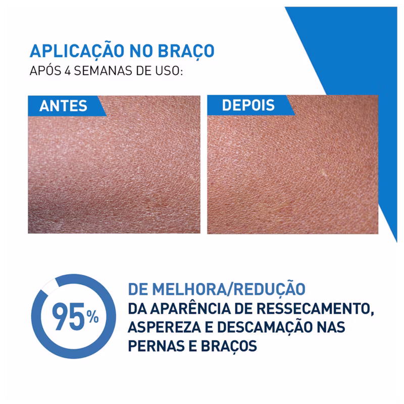 APLICAÇÃO NO BRAÇO
APÓS 4 SEMANAS DE USO:
ANTES - DEPOIS
95% DE MELHORA/REDUÇÃO
DA APARÊNCIA DE RESSECAMENTO, ASPEREZA E DESCAMAÇÃO NAS PERNAS E BRAÇOS