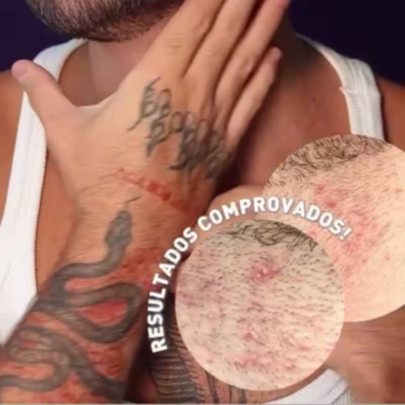 Tratamento Para Espinhas No Bumbum Foliculite Pelo Encravado