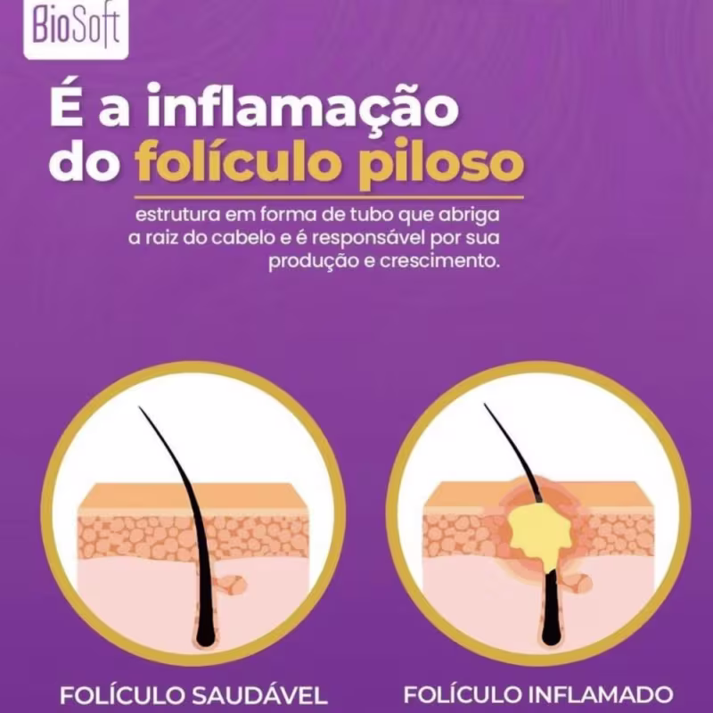 Foliculite E Pelo Encravado + Clareador Gluteo Virilha Coxa