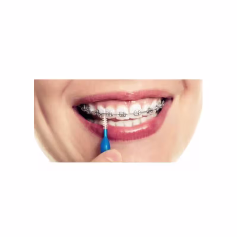 A imagem mostra um close up de uma boca com dentes utilizando aparelhos ortodônticos e utilizando a escova interdental.