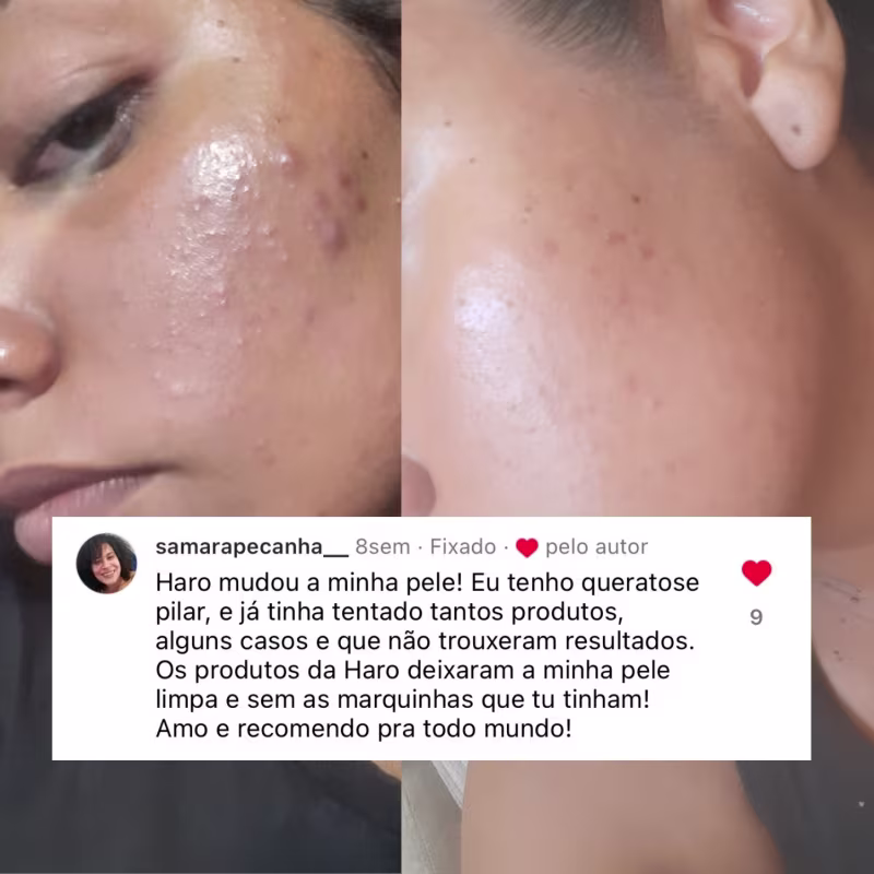 XÔ Espinhas e Manchas - 2 sabonetes