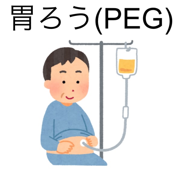 胃ろうとは 介護方法やデメリット 注意点まで全て解説 サービス付き高齢者向け住宅の学研ココファン