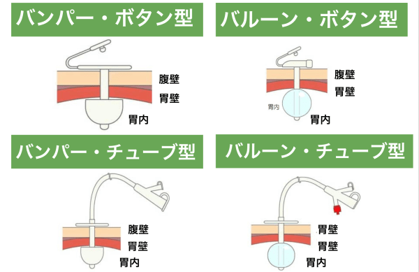 腸ろうカテーテル一覧