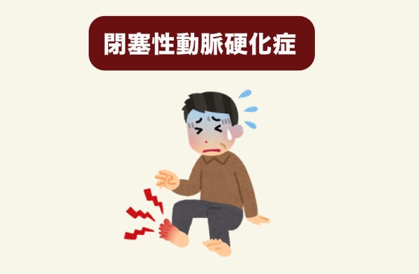 閉塞性動脈硬化症のイメージ