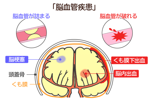 脳血管疾患