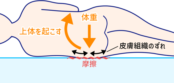 褥瘡ができる仕組み