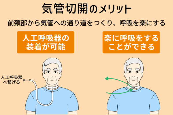 気管切開のメリットまとめ